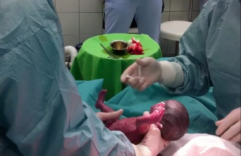 Lassabban fejlődnek a gyerekek, akik császármetszéssel jönnek a világra