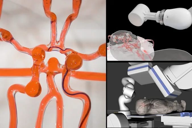 Életmentő lehet a stroke-betegeknek az új amerikai sebészrobot