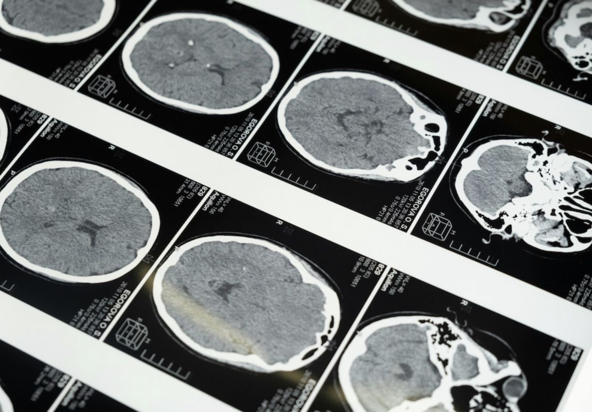 Úgy mutatja ki 88%-os pontossággal a demenciát egy új vizsgálat, hogy még a pontos típusát is megadja