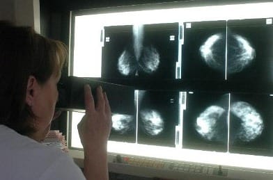 Krónikus gyulladások okozhatják a rákot