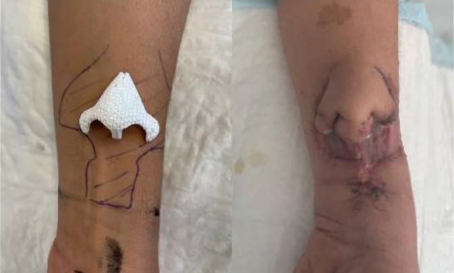 Orrot növesztettek egy beteg karjára, aztán átültették az arcára