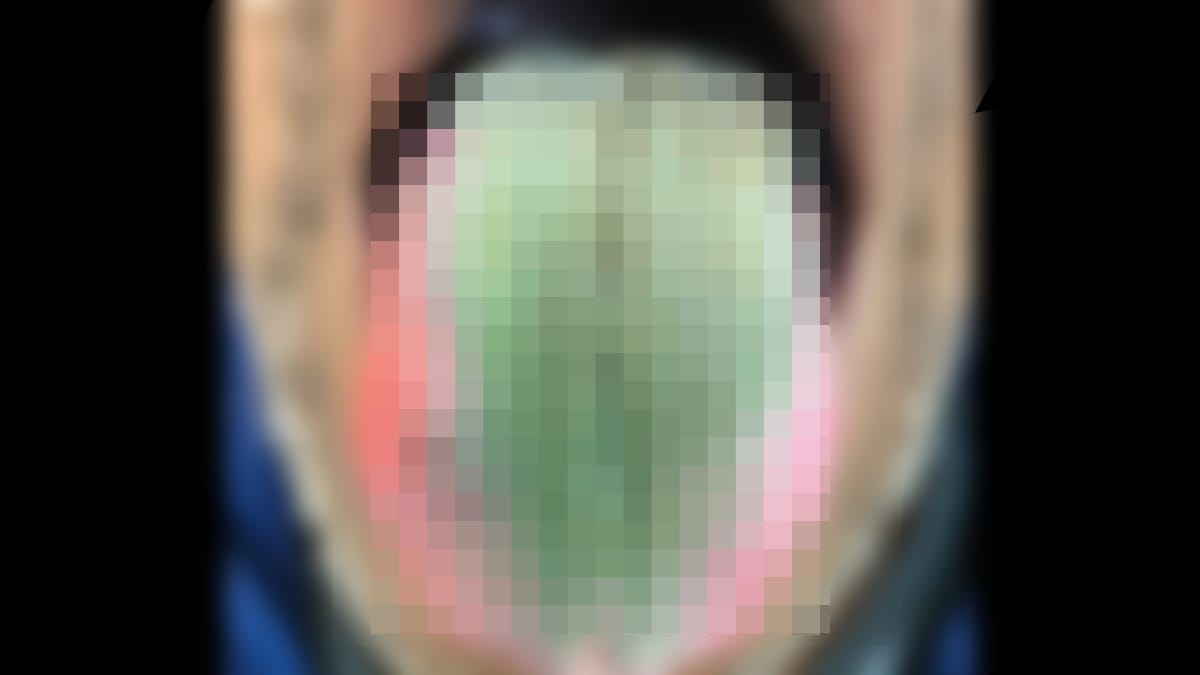 Szőrös zöld nyelve lett egy 64 éves dohányzó férfinak