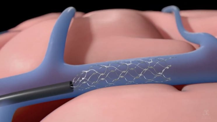 Megkapta az engedélyt a Neuralink konkurense, embereken tesztelhetik az agyi implantátumot