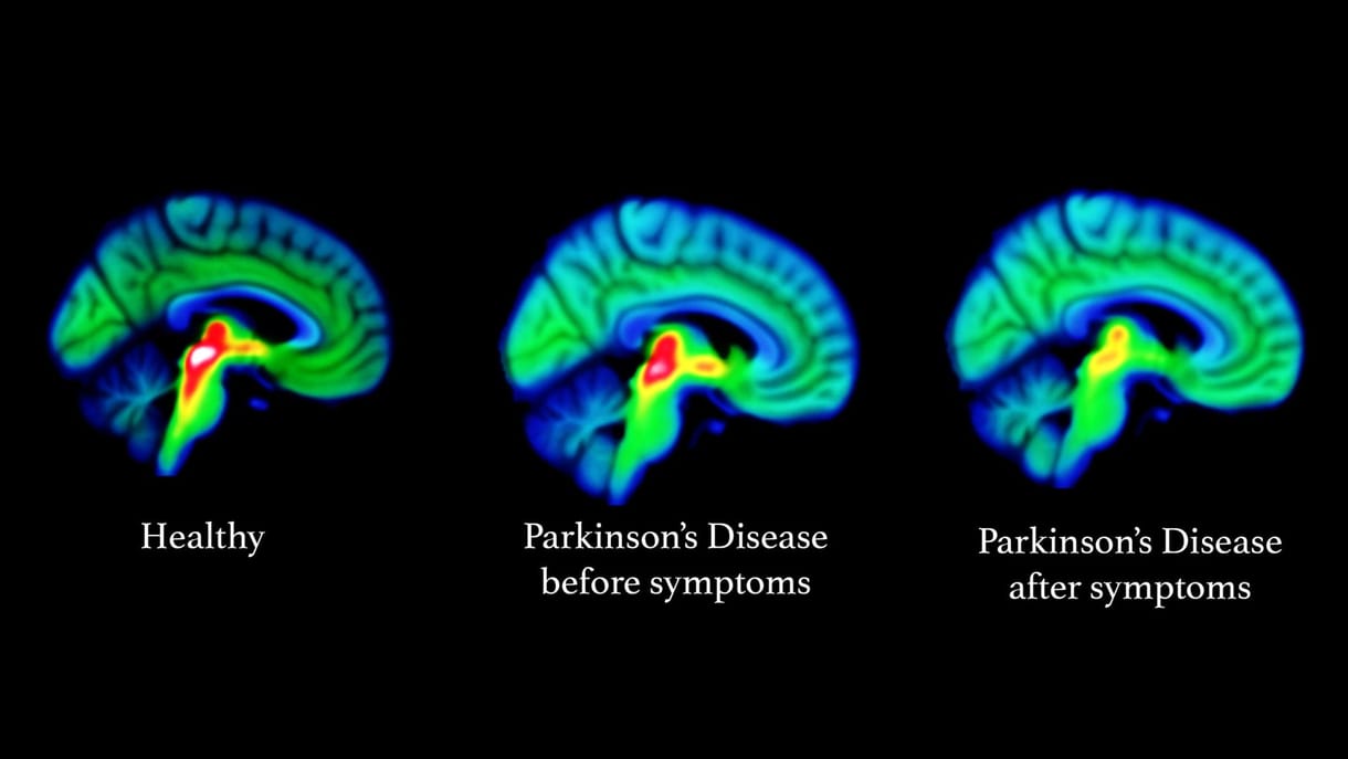 15-20 évvel korábban is látszik: megtalálták a Parkinson-kór legkorábbi jeleit az agyban