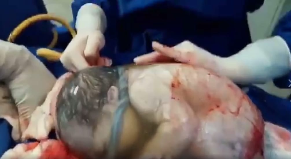 80 ezer szülésből 1 ilyen, ezért lett sztár egy spanyol baba – videó