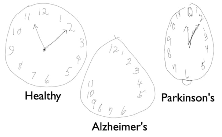 Csak rajzolni kell a képernyőre, és kiderítik, hogy érinti-e a Parkinson vagy az Alzheimer