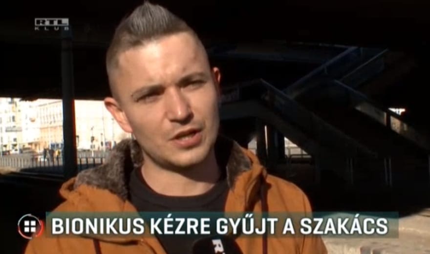 Bionikus kézre gyűjt a szakács, akit elgázolt a villamos Budapesten