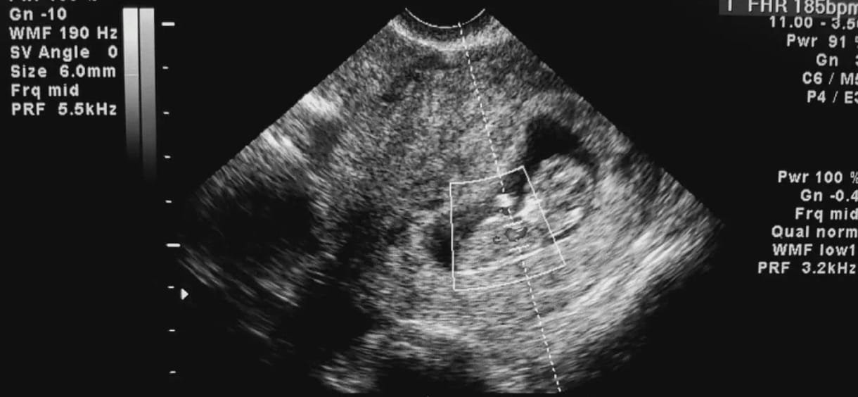 Az új abortuszrendelet nem segíti, hogy több gyermek szülessen, de a nők kiszolgáltatottabbak lettek