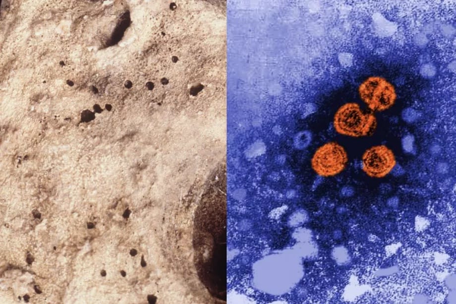 Egy 450 éve meghalt gyerek holttestében találhatták meg az eddigi legrégebbi hepatitis B vírust
