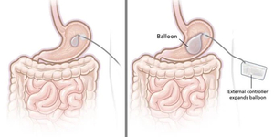 Szeretne lefogyni? Bizarr módszeren dolgoznak a kutatók, egy gyomorba helyezett ballon kell hozzá