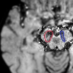 Ma már évtizedekkel meghosszabbítható a Parkinson-kórban szenvedők élete