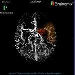 Stroke Magyarországon: amikor az idő halálos veszélyt jelent, akkor lép közbe a mesterséges intelligencia