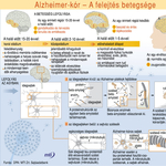 Az Alzheimer-kór összetéveszthetetlen tünetei    