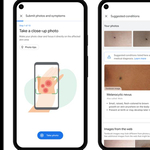A Google új alkalmazása ránézésre megmondja, milyen bőrbetegsége van az embernek
