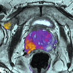 Új módszerrel diagnosztizálhatják a prosztatarákot