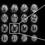 Van egy program, ami 6 évvel az orvosok előtt, eddig 100%-ban megmondta, kit fenyeget az Alzheimer-kór