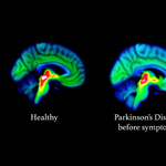 15-20 évvel korábban is látszik: megtalálták a Parkinson-kór legkorábbi jeleit az agyban