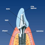 Csökkenhet a fogbeültetés ideje