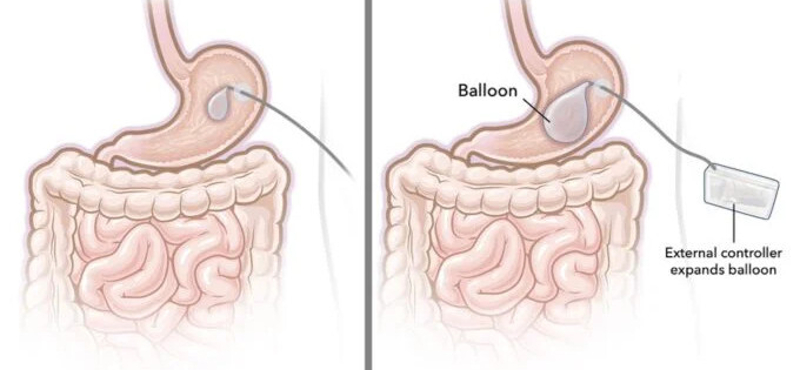 Szeretne lefogyni? Bizarr módszeren dolgoznak a kutatók, egy gyomorba helyezett ballon kell hozzá