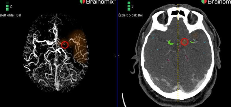 Stroke Magyarországon: amikor az idő halálos veszélyt jelent, akkor lép közbe a mesterséges intelligencia