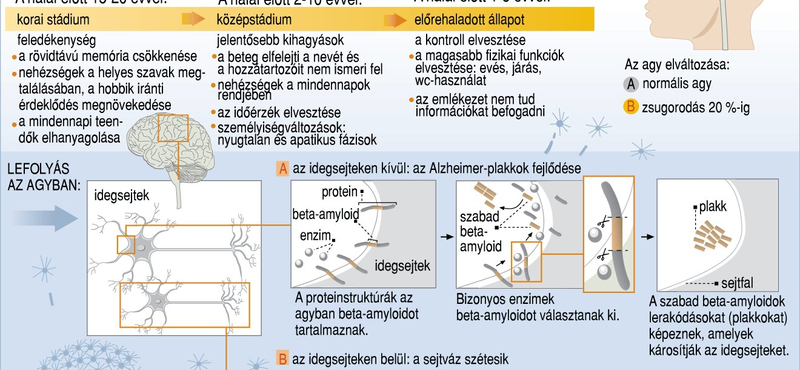 Az Alzheimer-kór összetéveszthetetlen tünetei    