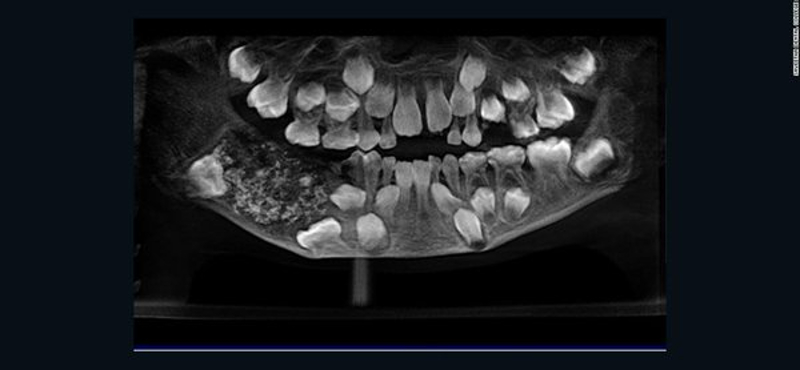 Fájt egy indiai kisfiú állkapcsa, aztán találtak benne 526 fogat