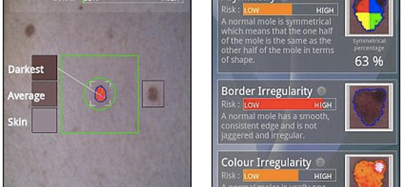 Így ellenőrizheti mobiljával a bőrrák jeleit