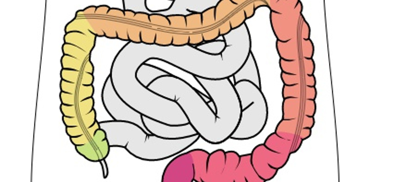 17 év tervezgetés és ígérgetés után elindul az országos vastagbélszűrés