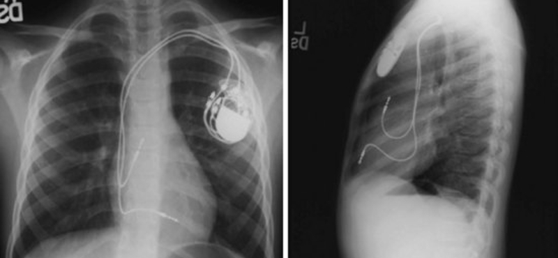 Semmelweis Egyetem: 1200 magyar szívben van visszahívott pacemaker