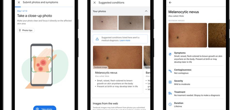 A Google új alkalmazása ránézésre megmondja, milyen bőrbetegsége van az embernek