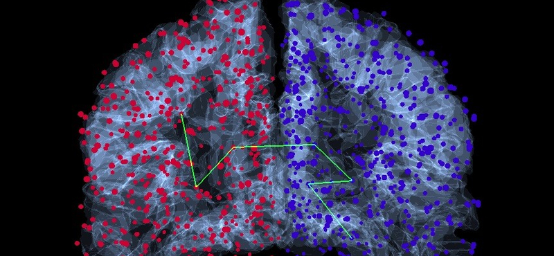 Az öregedés jeleit mutatja az agy, ha valaki súlyos koronavírus-fertőzésben szenved