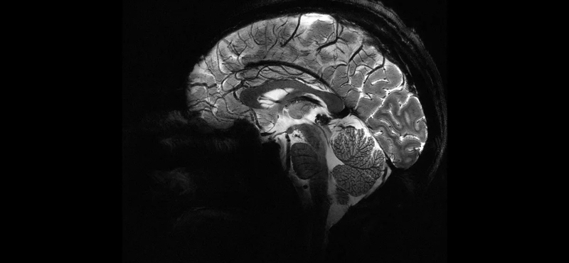 Bekapcsolták a világ legerősebb MRI-gépét, lenyűgöző, milyen képet készít az agyról