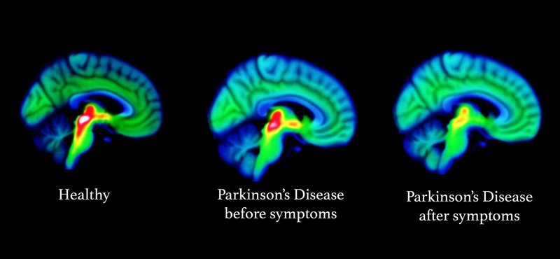 15-20 évvel korábban is látszik: megtalálták a Parkinson-kór legkorábbi jeleit az agyban