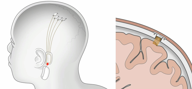 Megvalósulhat Elon Musk álma: még az idén chipet ültethet a Neuralink az emberi agyba