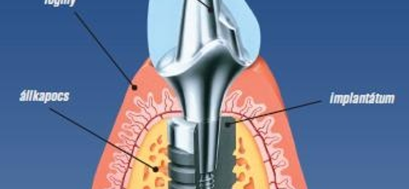 Csökkenhet a fogbeültetés ideje
